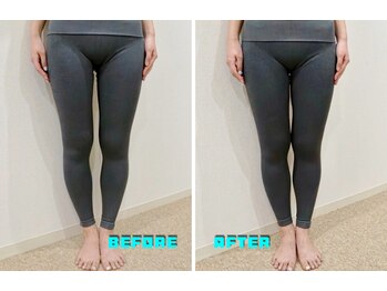 アズール(azure)/O脚矯正、ビフォー/アフター