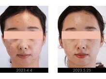 ボディアーキ 高知大丸店(BODY ARCHI)/お顔のbefore・after(約3ヶ月)