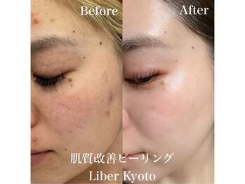 リベルキョウト 京都駅前店(Liber Kyoto)/肌質改善ピーリング