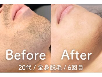 ユング 渋谷店(YUNG)/【ヒゲ脱毛】脱毛で毛穴レス肌！