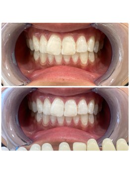 コナホワイトニング 神保町/ホワイトニング