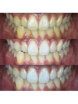 オーブハウス(aube house)の写真/初回￥2,980♪回数を重ねることで白さを実感◎笑顔に自信がつくセルフホワイトニング♪