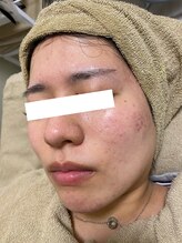 ノーブル 新宿南口(NOBLE)/新宿ハーブピーリングNOBLE