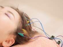 アロマプラス鍼灸院/人気沸騰♪頭皮鍼