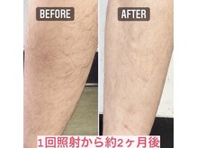 ピアーム(Pearm)/メンズ脱毛全身してます！