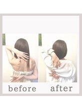 アリサナ(Arisana)/症例写真　肩甲骨はがし