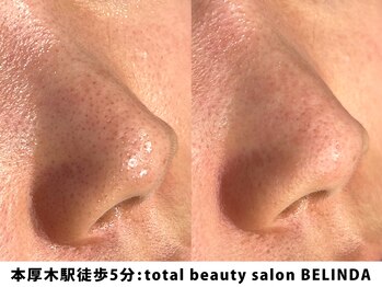 ベリンダ(BELINDA)/毛穴洗浄×セルマンピーリング