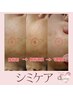 【シミケア】痛みも少なくダウンタイムなし♪黒くなってポロ◎