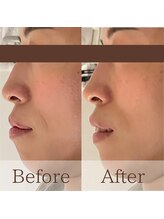 凪眠/小顔リンパフェイルの効果59