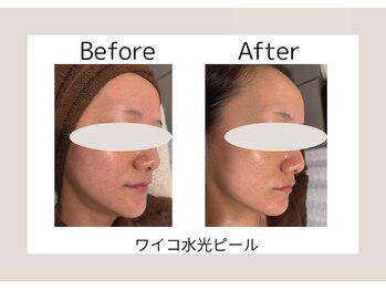 美成(vise)/ビフォーアフター