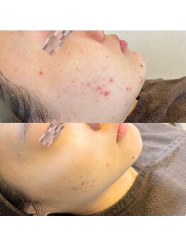 モモ(Momo.)/ハーブピーリング