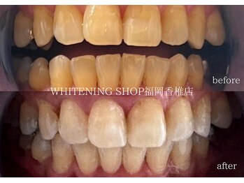 ホワイトニングショップ 福岡香椎店/美容ホワイトニングbefore after