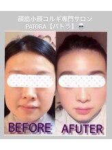 小顔骨気専門サロン パトラ(PATORA)/小顔コルギBefore＆After