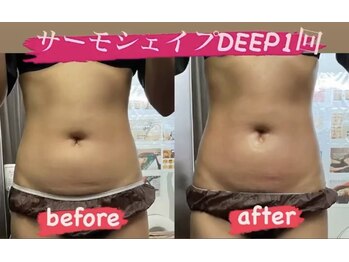 リラクゼーションサロン ラキ(laki)/サーモシェイプDEEP1回/痩身