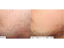 アレイズ(ARAYS)/症例(脱毛)