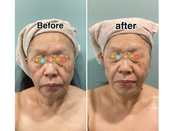 シェリアン バイ アイビー(Cherien by IVY)/しわケアカーボン光フェイシャル