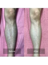 マジュエル majewel/men's全身脱毛