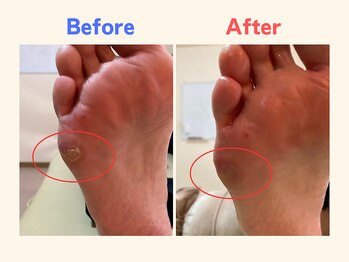 ピース/魚の目にお悩みの50代女性