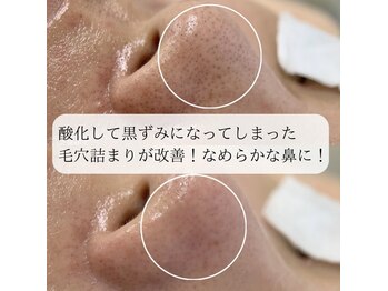 ミュー 岡崎店(mieux)/◇毛穴詰まりを速攻で解決します