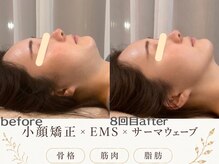 エスポワール(espoir)/二重顎・首ラインがスッキリ