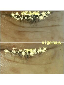 ヴィゴラス/本気の肌質改善ハーブピーリング