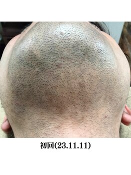 レイ(R.E.I)/【脱毛ビフォー】あご