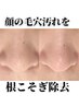 何をやっても変化なかった黒ずみに【毛穴角栓除去】全顔しっかり13,200円→