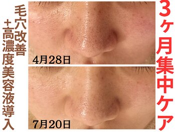 エリン(ERIN)/毛穴徹底洗浄×美容液導入