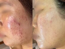 エヌエースキン 北谷店(NAskin)/ハーブピーリング｜ニキビケア