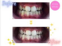 エクシアホワイト 広島袋町店/ホワイトニングビフォーアフター