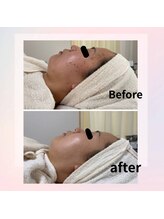 レゾン 京橋店/【Before/after】ニキビケア