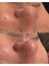サロン オ レヴィア(SALON.O.REVIA)/メンズ水素毛穴洗浄