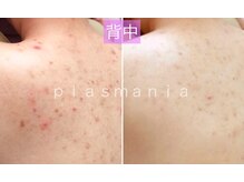 ミピブ 梅田(mipibu)/背中ケア　aiplus &プラズマケア