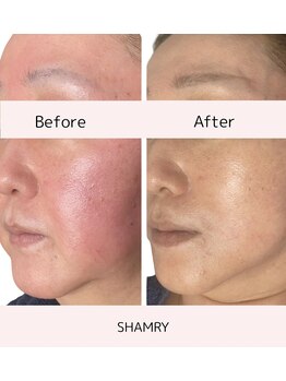 シャムリー(SHAMRY)/SEN管理／ホームケア