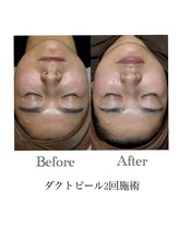 ゼニス 池袋本店(ZENITH)/エクソソーム入『ダクトピール』