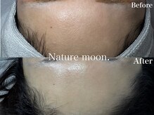 ナチュールムーン(Nature moon.)/ハーブピーリング