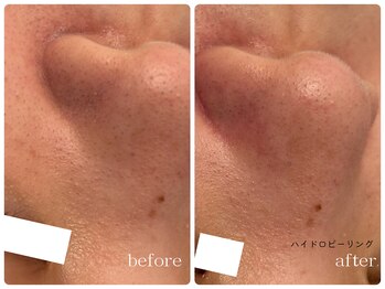 メゾンリュバン 天王寺(Maison Ruban)/毛穴洗浄(ハイドロピーリング)