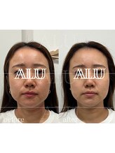 アルフォービューティー 難波店(ALU for beauty)/オンダリフト症例