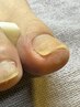 【巻き爪の爪切り】男性にも◎看護師がする両足の爪切り　母趾の甘皮ケア込み