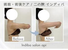 アピ(api)/症例写真【インディバ】
