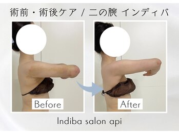 アピ(api)/症例写真【インディバ】