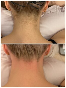 ルノン(LUNON)/うなじWax脱毛