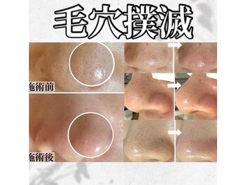 ホワイトアクア 中目黒店(WHITE AQUA)/ハーブピーリング/毛穴/中目黒