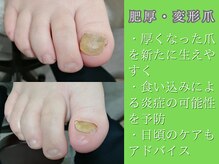 厚くなった爪はそのままにしていても良くなりませんご相談を！