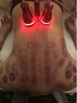 中国整体 らくらく堂/温熱療法吸い玉デトックス