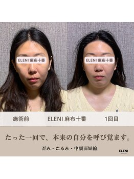 エレーニ 麻布十番(ELENI)/フェイスラインが整った