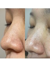 ラトゥール(Latour)/毛穴スッキリ♪