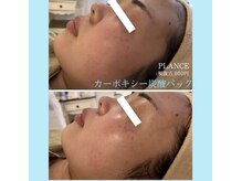 プランス 福岡(PLANCE)/韓国肌管理　福岡天神エステ
