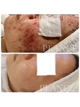 プランス 渋谷(PLANCE)/毛穴/ハーブ/ニキビケア