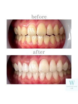 ホワイトニングショップ 長野店/【当店人気NO.1】3週間通い放題